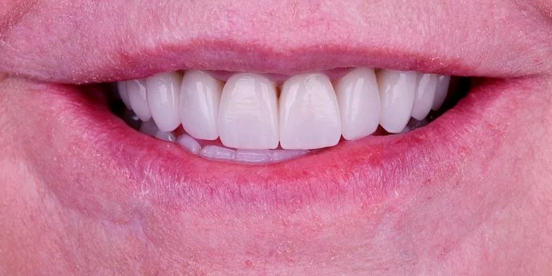 После - Керамические коронки и виниры Emax